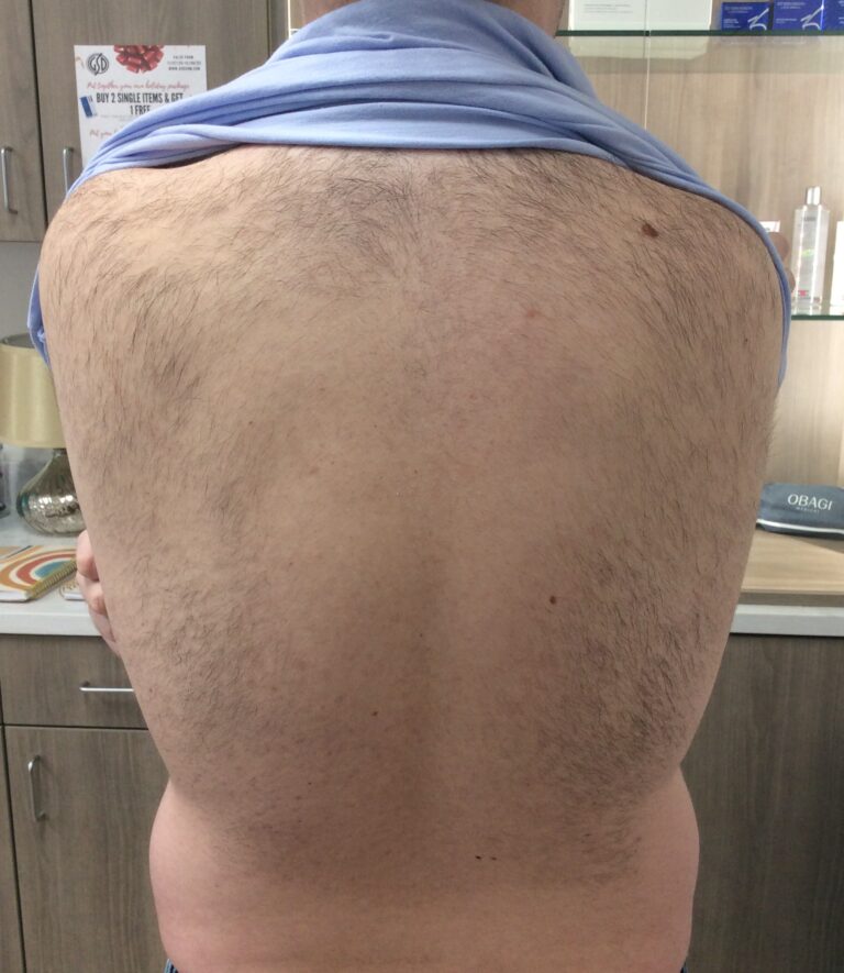 Before Image: Laser Hair Removal – Back - back