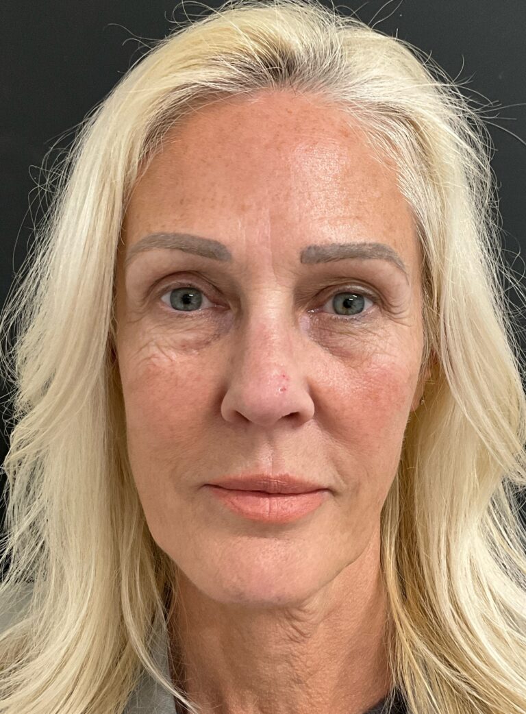 Before Image: Matrix Pro RF Applicator Face - front