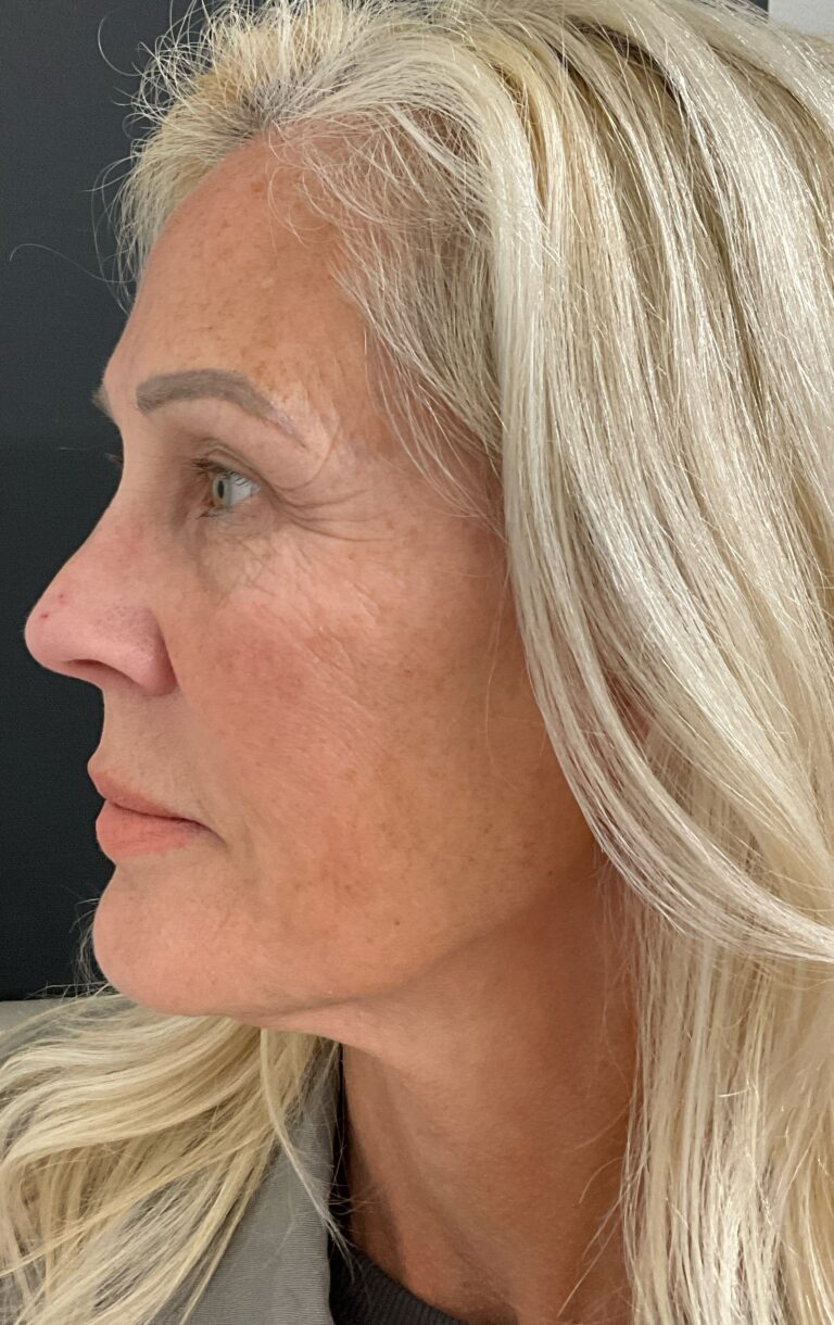 Before Image: Matrix Pro RF Applicator Face - left-side