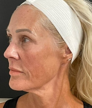 After Image: Matrix Pro RF Applicator Face - left-side