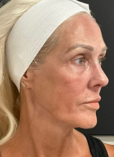 After Image: Matrix Pro RF Applicator Face - right-side
