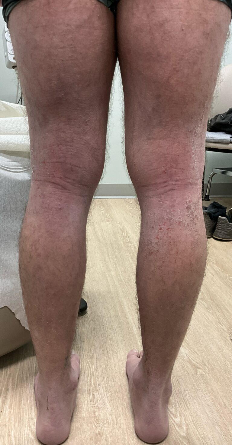 Before Image: UV Phototherapy for Atopic Dermatitis (Eczema) - front
