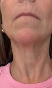 After Image: Matrix Pro RF Applicator Chin and Jaw Area