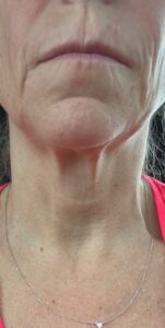 Before Image: Matrix Pro RF Applicator Chin and Jaw Area