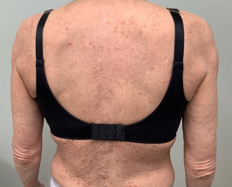 Before Image: UV Phototherapy for Atopic Dermatitis (Eczema) - back